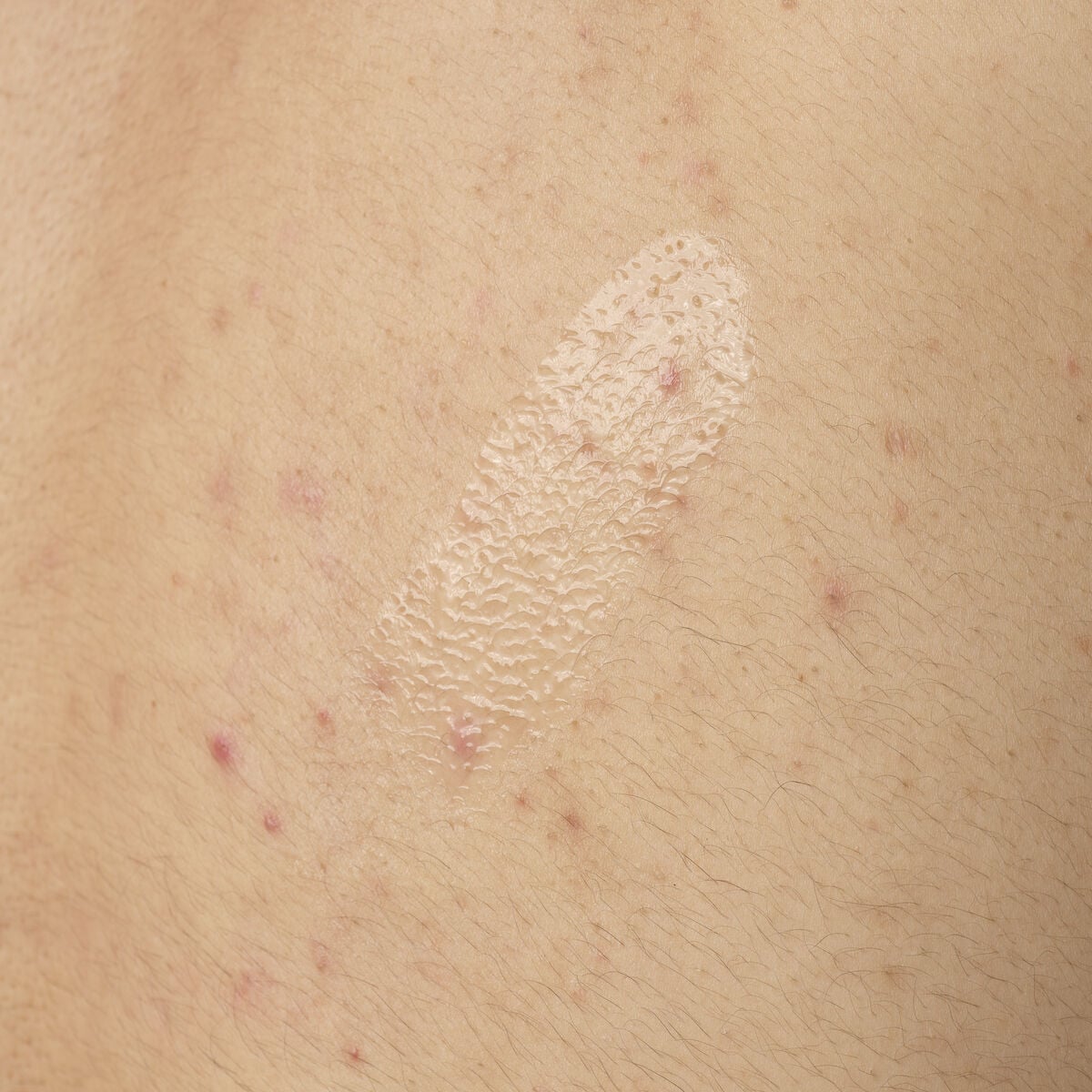 salicylic-acid-0-5-body-serum-z4 ORD-salicylic-acid-05-body-240ml-application.jpg