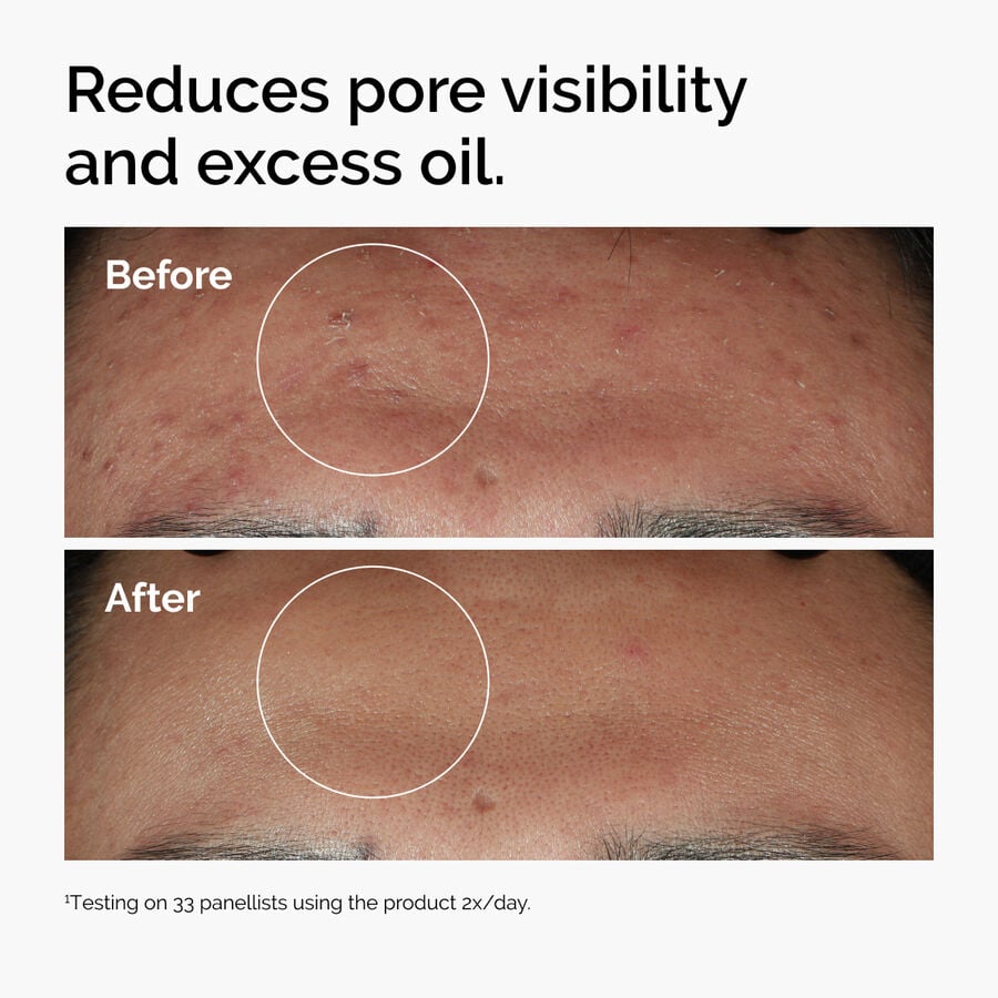 niacinamide-10-zinc-1-o9 ord-niacinamide-zinc-blemish-serum-before-after-pores.jpg