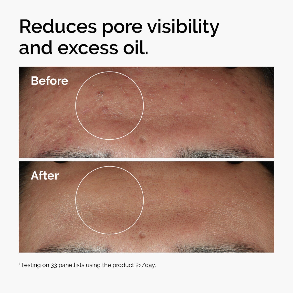 niacinamide-10-zinc-1-o9 ord-niacinamide-zinc-blemish-serum-before-after-pores.jpg