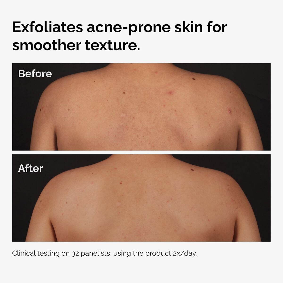 salicylic-acid-0-5-body-serum-z4 ord-salicylic-acid-body-serum-before-after-graphic-NA.jpg